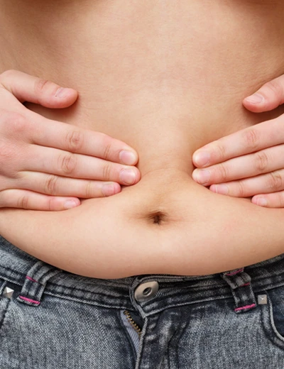 Diastasis Recti